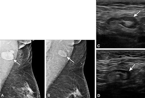 lymphadenopathy