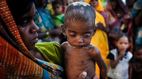 Malnutrition and Poor Health Status