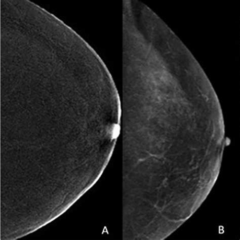 mammography