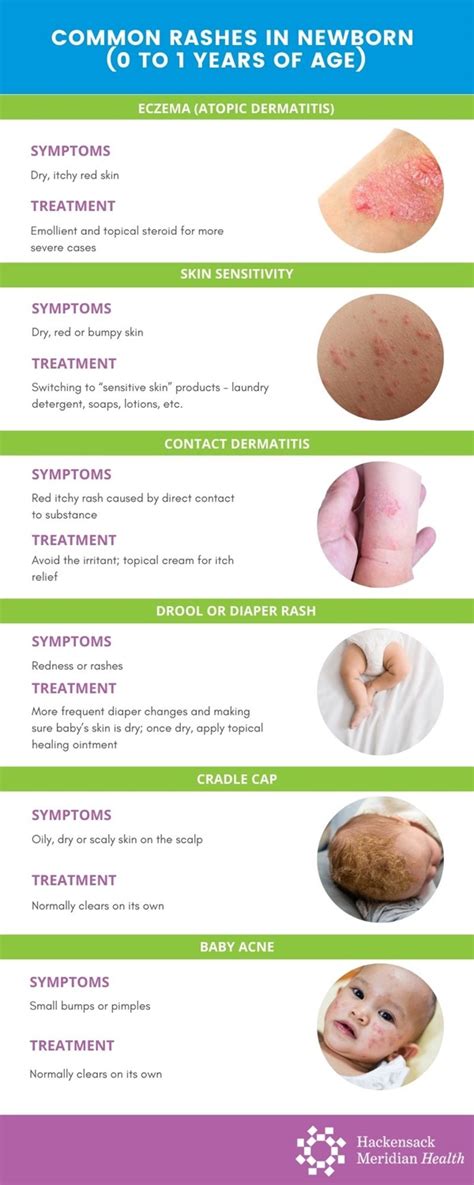 management of viral rashes