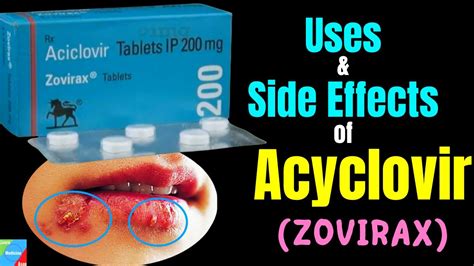 Managing Acyclovir Side Effects