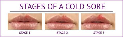 Managing Cold Sore Outbreaks