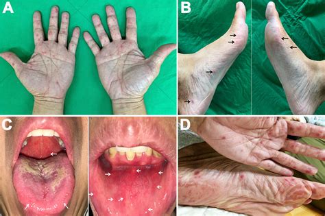 Managing HFMD