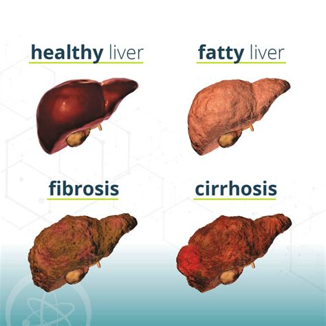 Mash Liver Disease Causes