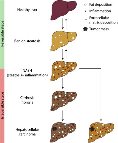 Mash Liver Disease Conclusion