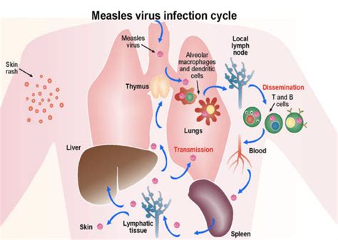 Measles Transmission