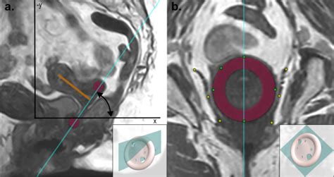 mechanism of vaginal ring birth control