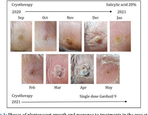 Medical Interventions for Plantar Warts