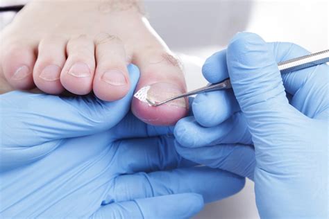 Medical Treatments for Ingrown Nail