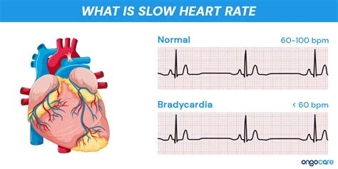medication to slow heart rate