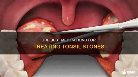 Medications for tonsilloliths