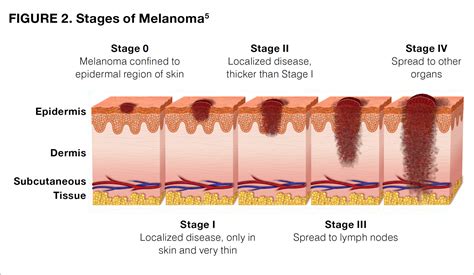 Melanoma Introduction