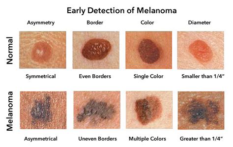 Melanoma skin cancer