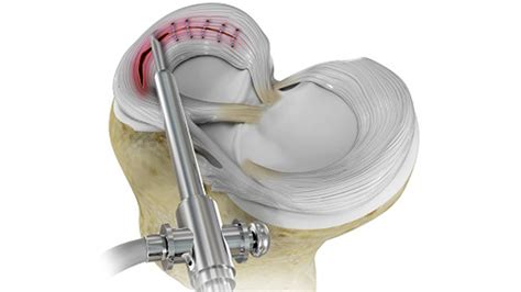 Meniscal Repair
