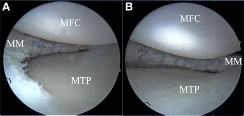 Meniscus Tear Repair Techniques