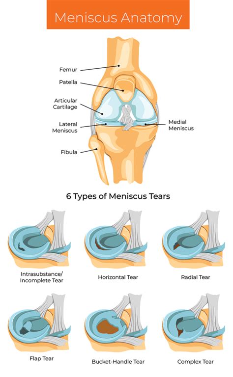 Meniscus Tear Surgery Alternatives