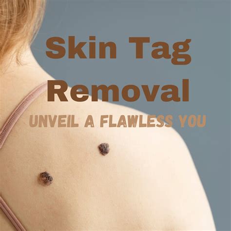methods of skin tag removal