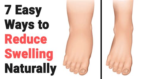 Methods to Reduce Swelling