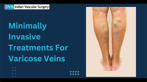 minimally invasive varicose vein removal