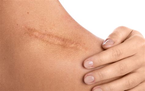minimizing scarring