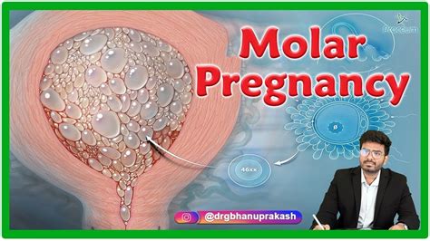 molar pregnancy causes