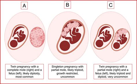 molar pregnancy living
