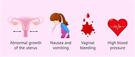 molar pregnancy symptoms