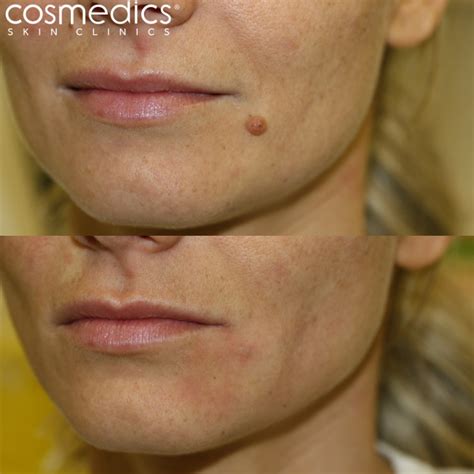 Mole Removal Conclusion