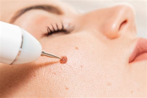 Mole Removal Risks