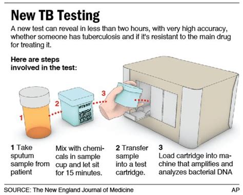 Molecular-Based TB Lab Test