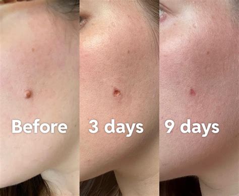 Moles Removal