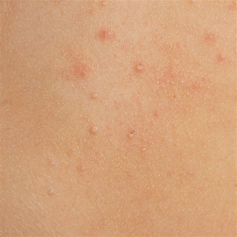 Molluscum Contagiosum