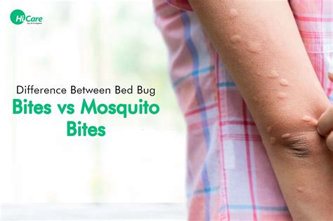 mosquito bites