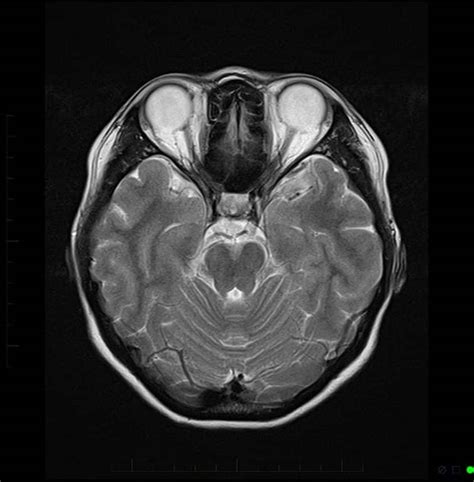 MRI Scan of the Brain