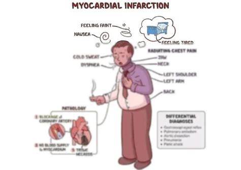 myocardial infarction symptoms
