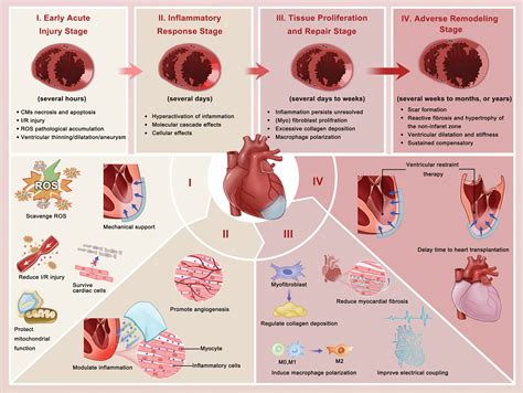 myocardial infarction treatment