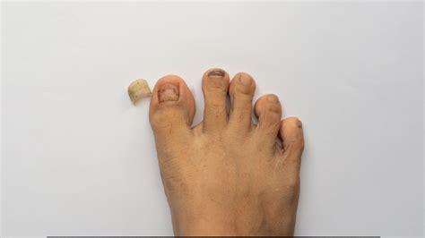 nail falling off