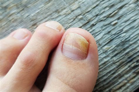 ketoconazole cream for nail fungal infections