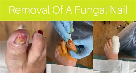 nail fungus removal methods