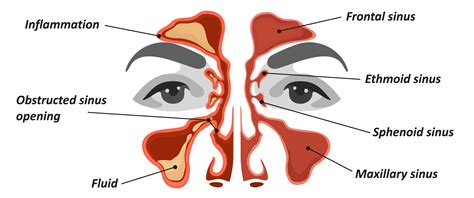 Nasal Congestion