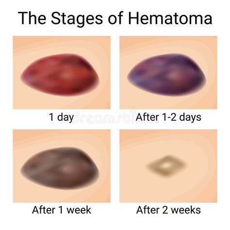 Natural Healing Methods for Hematomas