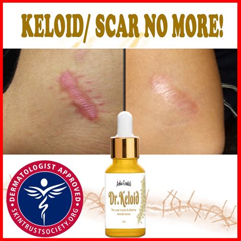 Natural keloid scar removal methods