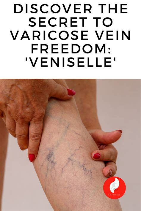 Natural Methods for Removing Varicose Veins
