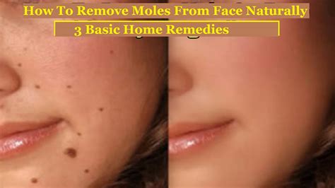 Natural Mole Removal