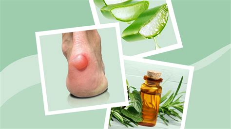 Natural Remedies for Blisters