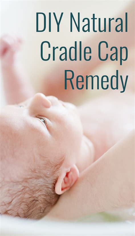 Natural Remedies for Cradle Cap