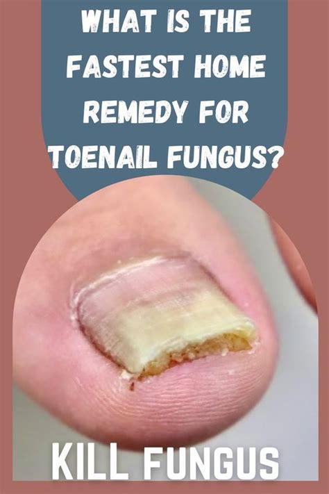 Natural Remedies for Fungus Toenail Infections