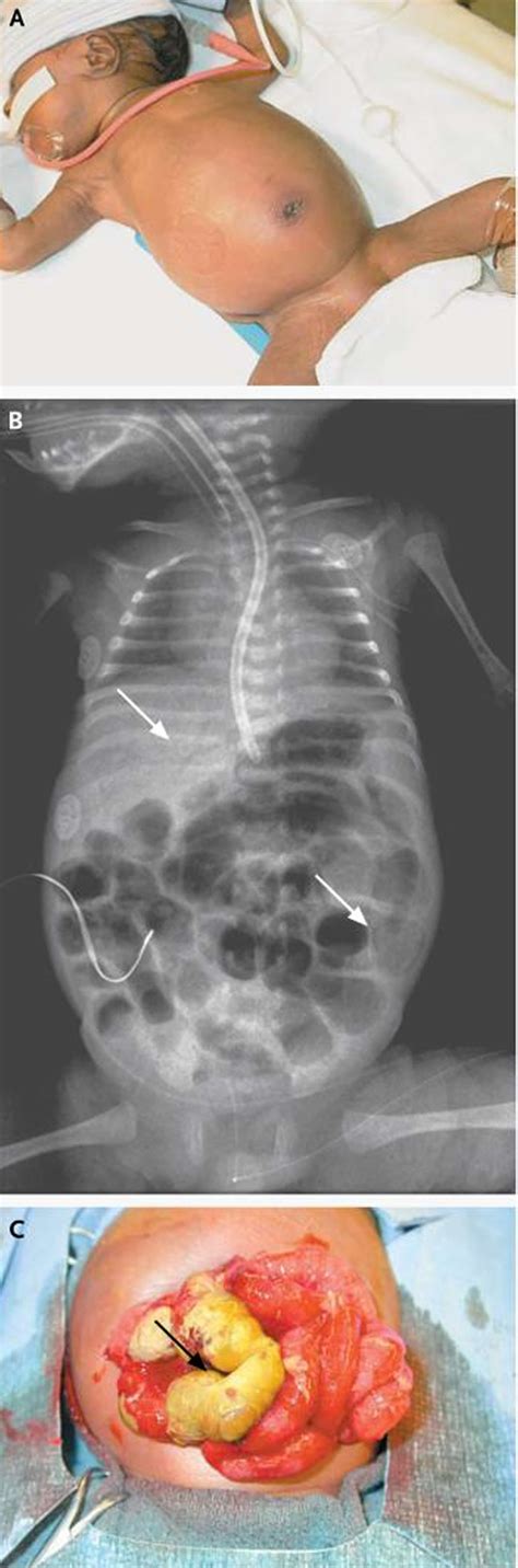 Necrotizing Enterocolitis Complications
