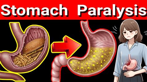 neurological disorders and stomach paralysis