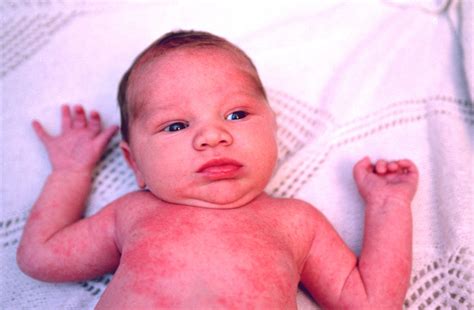 newborn heat rash complications